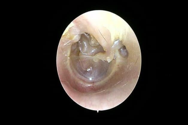 xẹp nhĩ do viêm tai giữa