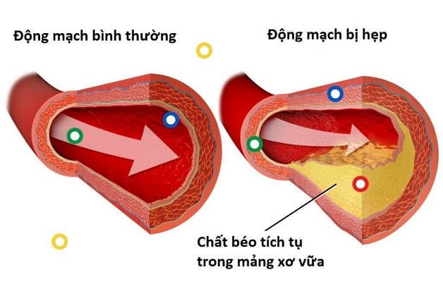 Xơ cứng động mạch vành là gì?