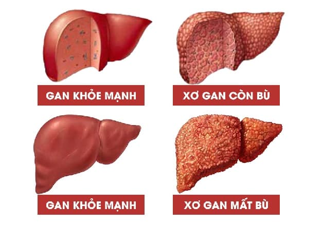 Bệnh xơ gan thường được phân thành hai loại là xơ gan còn bù và mất bù