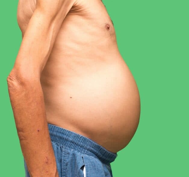 Bụng phình to là dấu hiệu điển hình của xơ gan mất bù