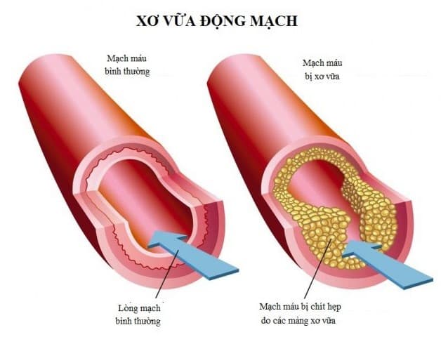 xơ vữa động mạch