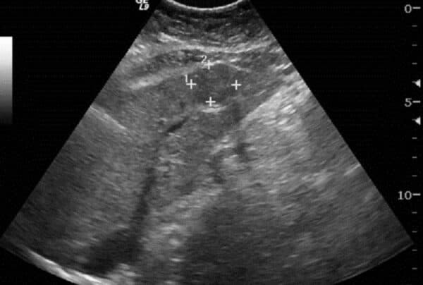 phương pháp điều trị ung thư gan