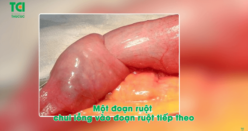 Trẻ bị lồng ruột, bố mẹ đừng chủ quan