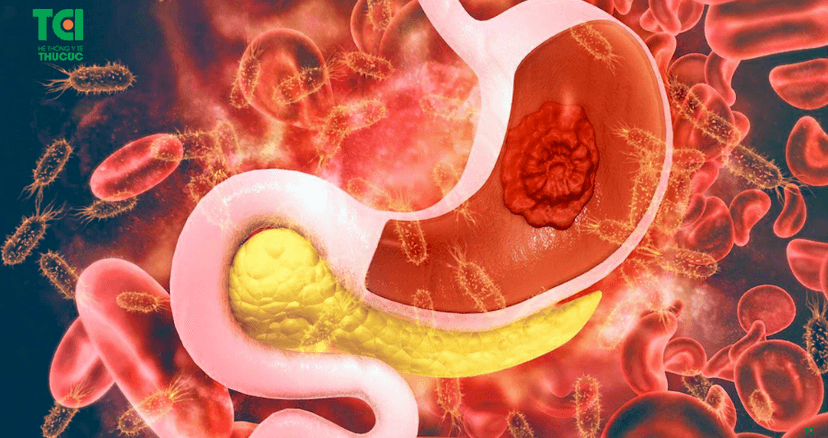 Vi khuẩn HP dạ dày có thực sự nguy hiểm không?