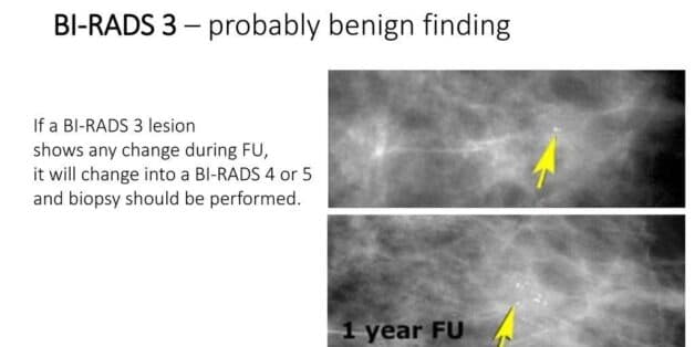 Nhân tuyến vú birads 3 khi siêu âm