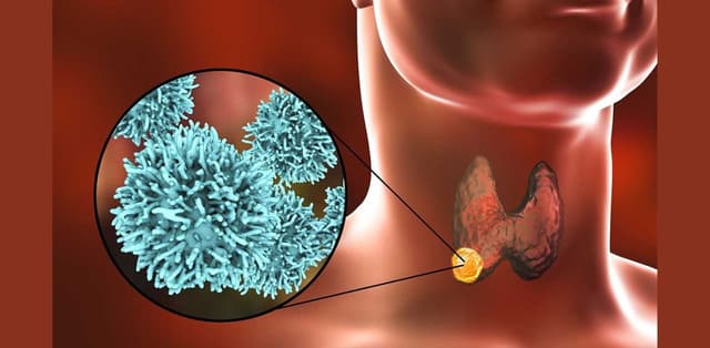 U nang tuyến giáp: Nguyên nhân, triệu chứng và cách điều trị