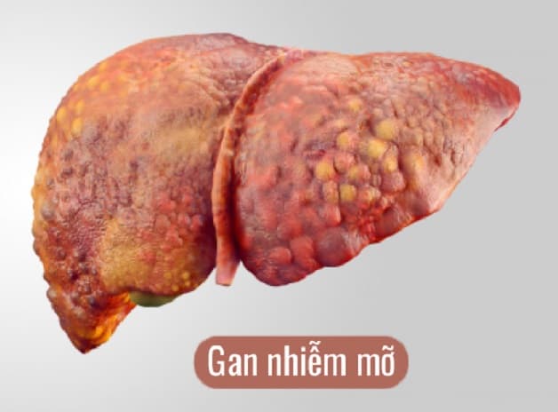 Tổng quan về bệnh gan nhiễm mỡ