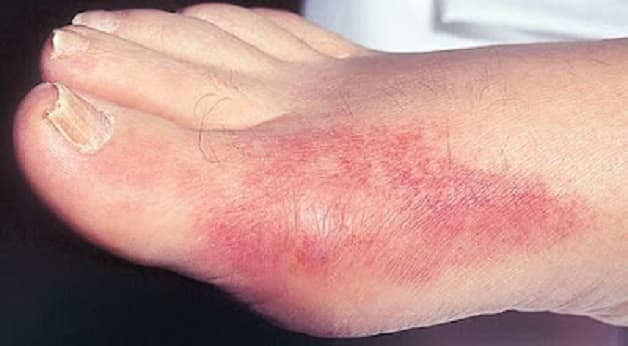 bệnh gút ban đỏ 