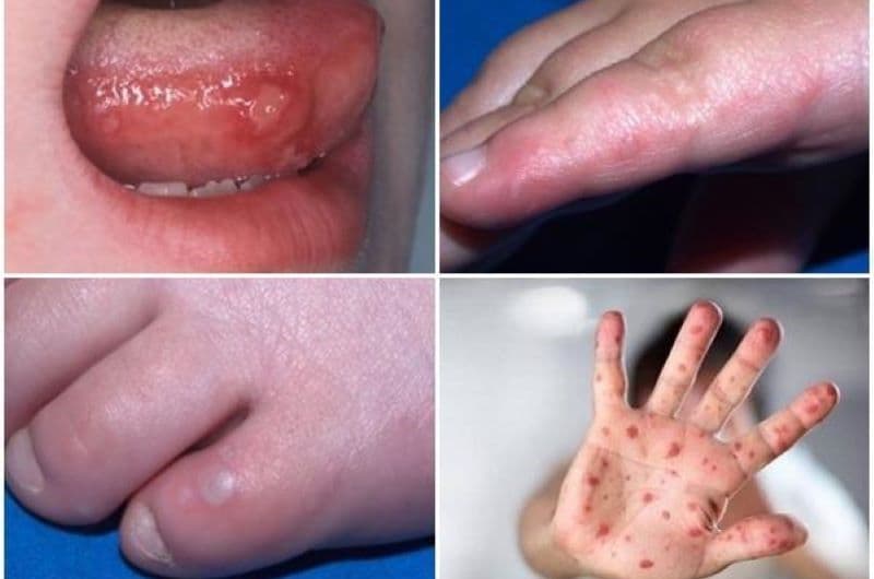 Xem ngay: Hình ảnh bệnh tay chân miệng ở trẻ em