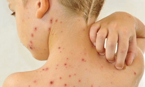 bệnh thủy đậu có ngứa không