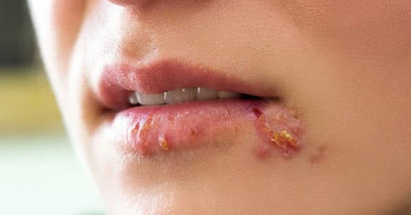 bệnh tình dục lây qua đường miệng 