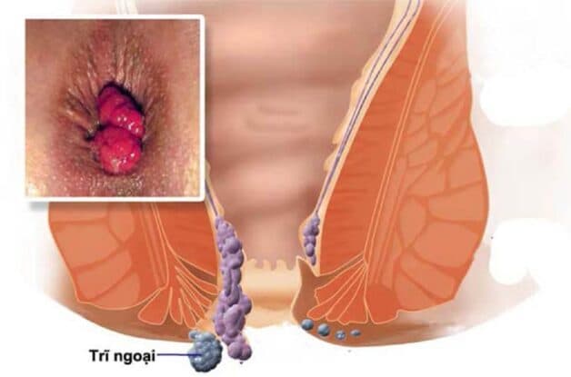 Bệnh trĩ ngoại cấp độ 4 như thế nào