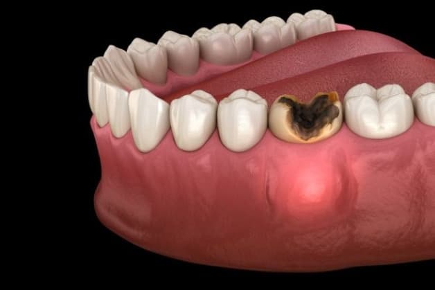 cách trị sâu răng đen