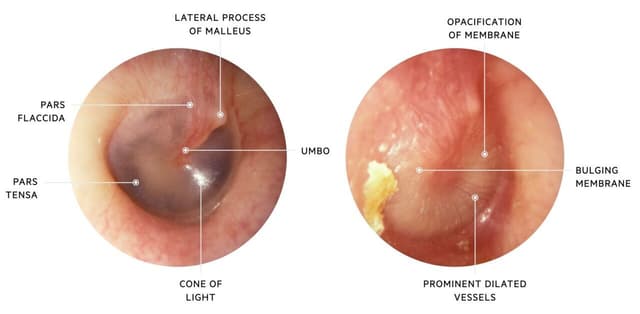 Cách trị viêm tai giữa đúng đắn bố mẹ phải biết