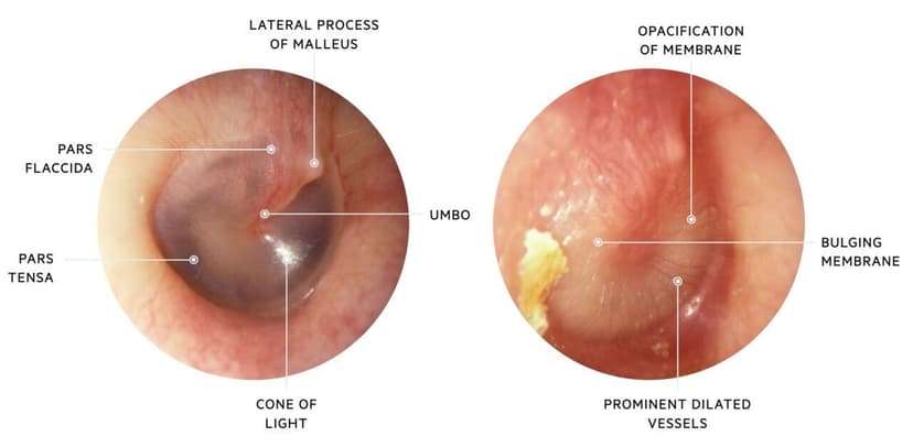 Cách trị viêm tai giữa đúng đắn bố mẹ phải biết
