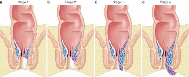 Hình ảnh mô phỏng các cấp độ của bệnh trĩ