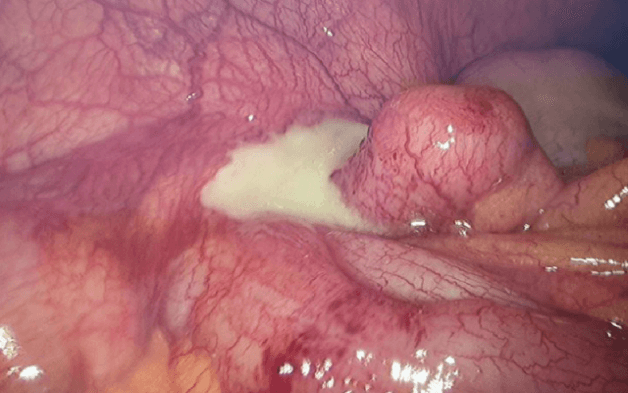 Viêm phúc mạc là biến chứng nguy hiểm nhất, xảy ra khi ruột thừa bị viêm và vỡ, chảy vào ổ bụng.