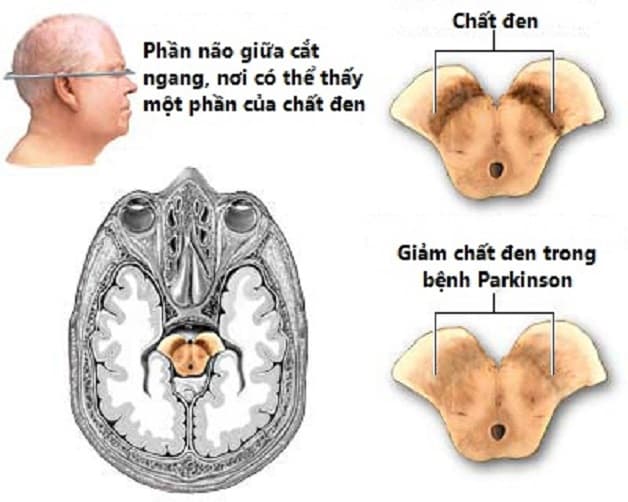 Cơ chế bệnh parkinson
