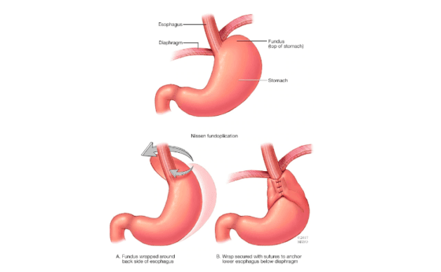Phẫu thuật fundoplication là phương pháp điều trị trào ngược được áp dụng phổ biến.