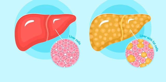 Gan nhiễm mỡ có tác hại gì và cách kiểm soát