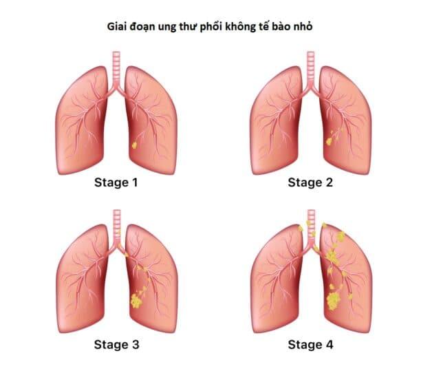 Ung thư phổi có những giai đoạn nào và tiên lượng điều trị ung thư phổi