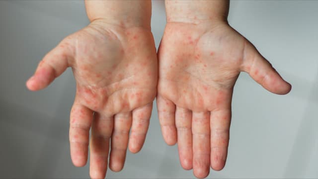 Xem ngay: Hình ảnh bệnh tay chân miệng ở trẻ em