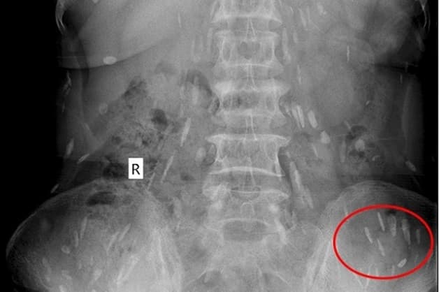 Người nhiễm sán có thể bị đau bụng, tiêu chảy, buồn nôn...