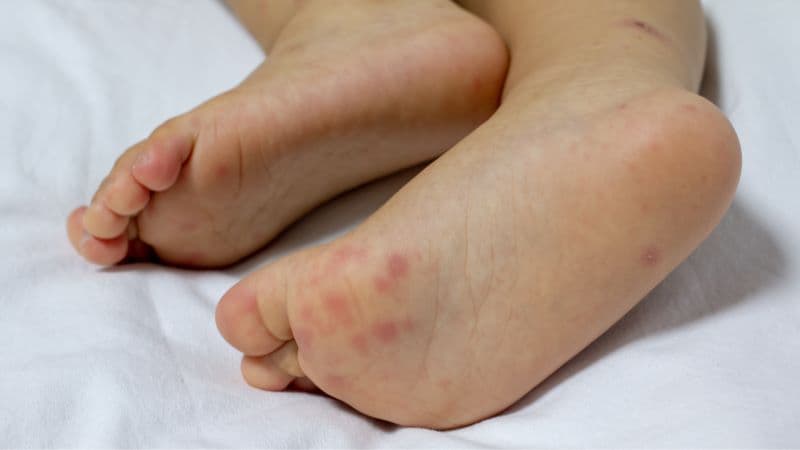 Xem ngay: Hình ảnh bệnh tay chân miệng ở trẻ em