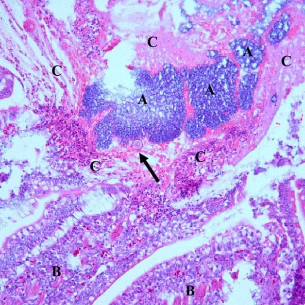 Hoại tử đường ruột là bệnh nguy hểm ở hệ tiêu hóa