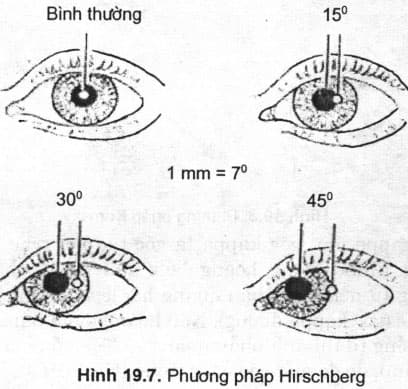 Khám bằng phương pháp Hirchberg