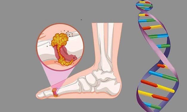 nguyên nhân gây bệnh gút ban đỏ 