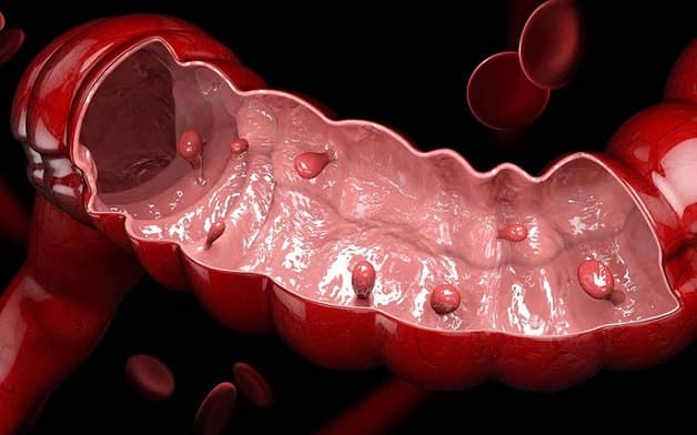 Polyp đại tràng là bệnh thường gặp ở hệ tiêu hóa