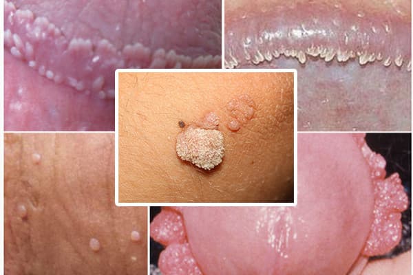 Sùi mào gà là bệnh lây nhiễm do virus HPV gây ra