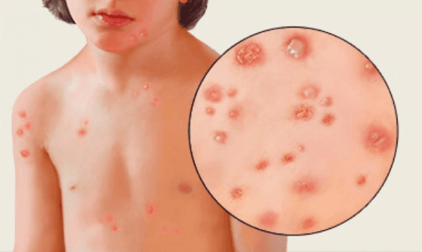 Xử lý mụn nước thủy đậu cho trẻ đúng cách, an toàn-2