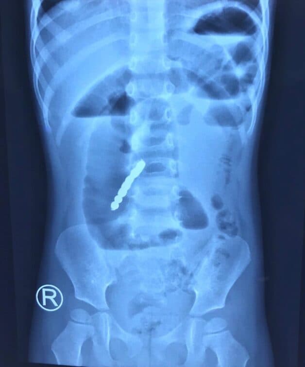 nuốt dị vật ở trẻ em