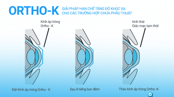 Kính Ortho - K hay kính áp tròng cứng