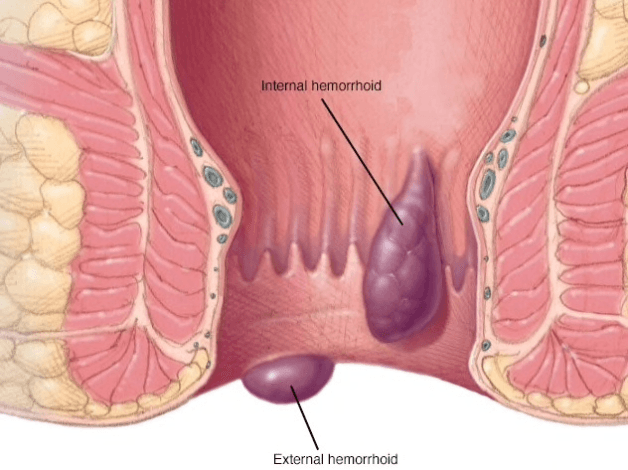 phân loại bệnh trĩ