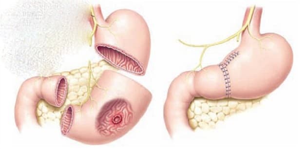 Điều trị bệnh ung thư dạ dày theo giai đoạn