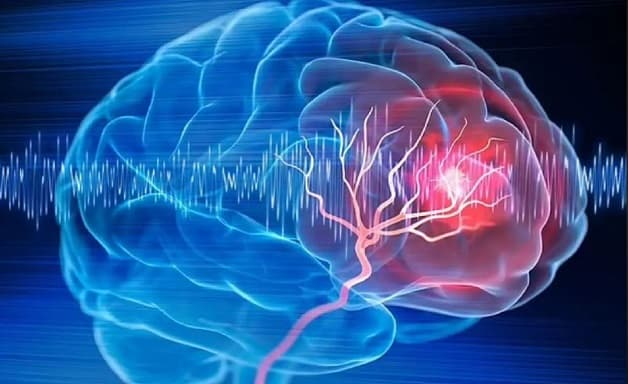 sa sút trí tuệ sau đột quỵ