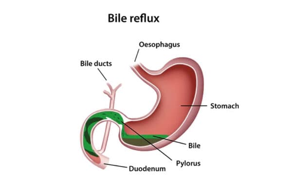 Nguyên nhân trào ngược dịch mật dạ dày