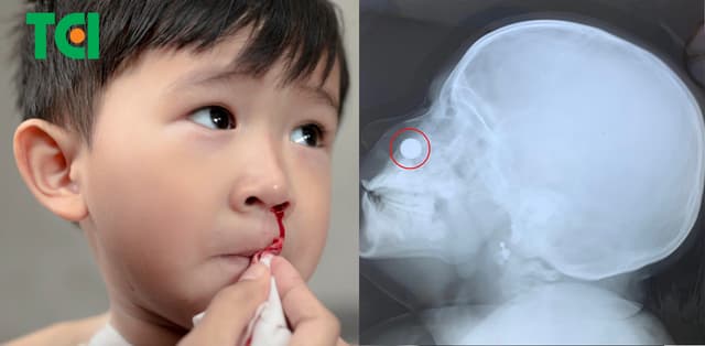 Cẩn trọng tình huống trẻ em nhét dị vật vào mũi