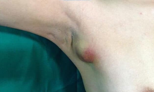 Hình ảnh tuyến vú phụ vùng nách