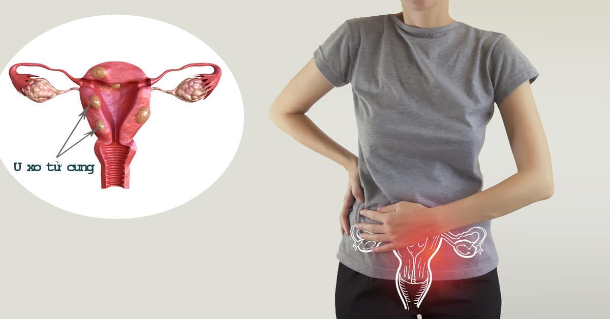 Kinh nguyệt không đều, ra máu bất thường là biểu hiện của u xơ tử cung