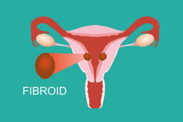 Mắc u xơ tử cung uống cây gì để cải thiện bệnh?