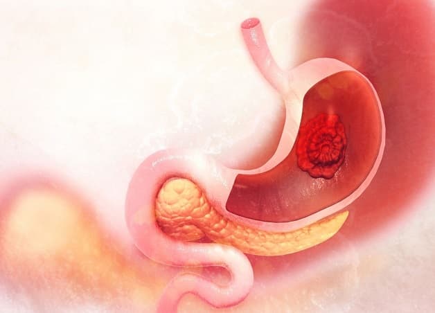 Bệnh ung thư dạ dày