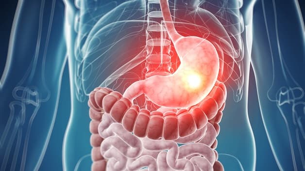 Giai đoạn ung thư dạ dày