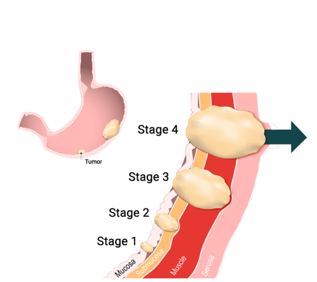 Các giai đoạn ung thư dạ dày tiến triển như thế nào
