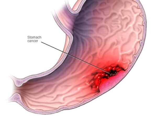 các giai đoạn ung thư dạ dày