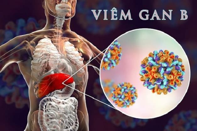 viêm gan nhiễm mỡ