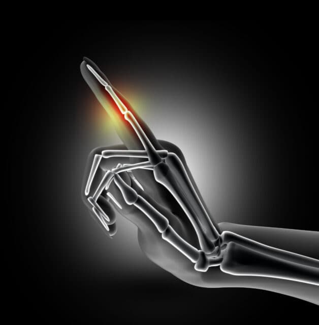 Tình trạng gân dày lên khiến việc uốn cong ngón tay khó khăn.